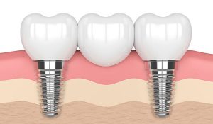 Implantatgetragenen Zahnersatz in Ungarn